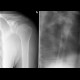 Abruption of the rim of glenoid: X-ray - Plain radiograph